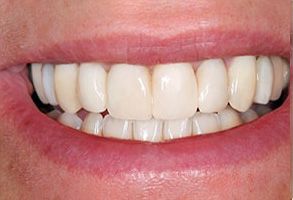 Keledjian Dental | Orthodontics, Extractions and Ceramic Crowns